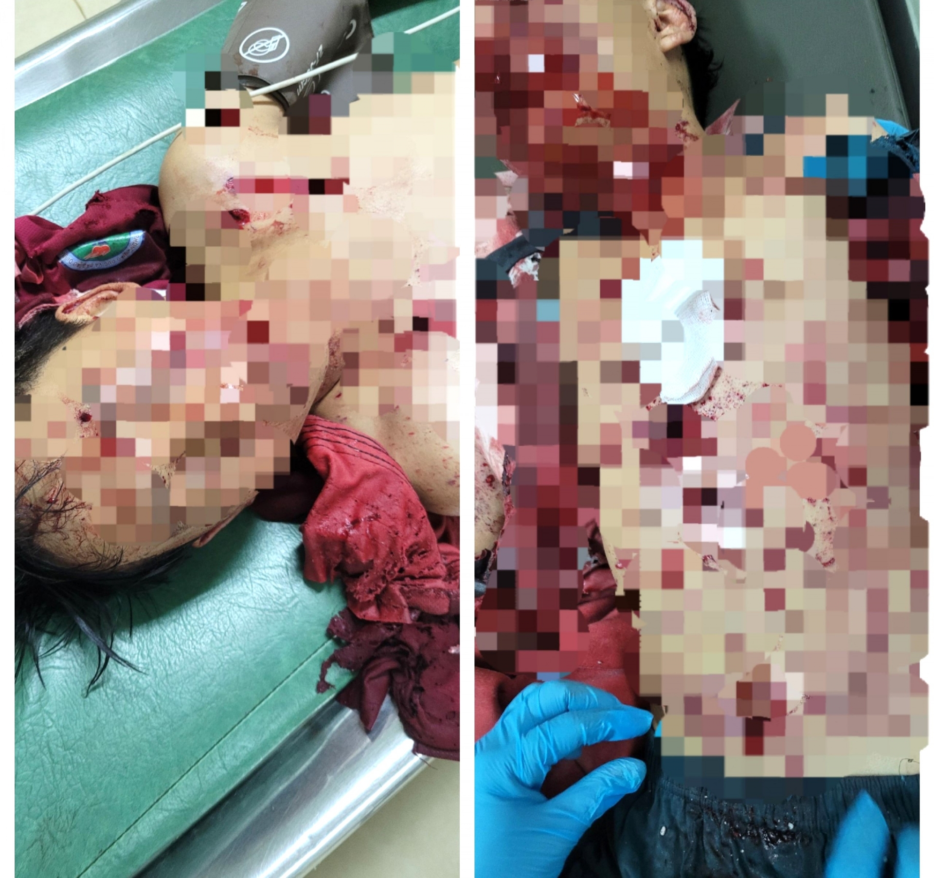 Di Linh: Pháo tự chế phát nổ, 2 học sinh nguy kịch