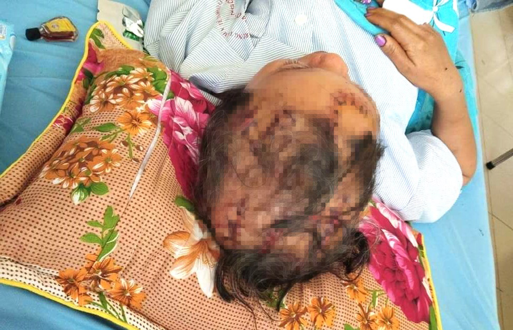 Đạ Huoai: Vợ chấn thương sọ não nghi do chồng hành hung