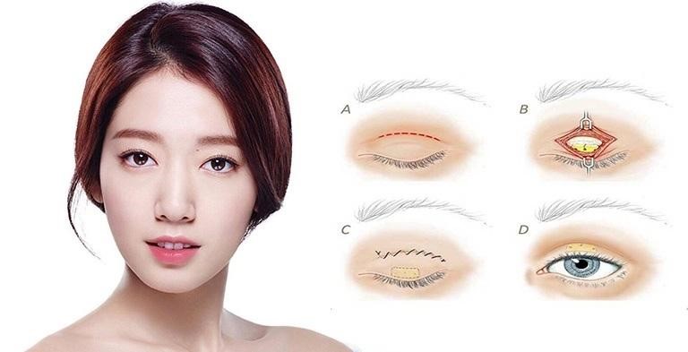 Cắt mí Hàn Quốc- Bí quyết sở hữu đôi mắt ấn tượng tự nhiên