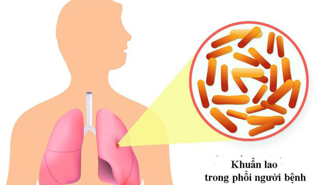 CHỈ ĐẠO, QUYẾT ĐỊNH CỦA CHÍNH PHỦ - THỦ TƯỚNG CHÍNH PHỦ: Thủ tướng chỉ đạo tăng cường công tác phòng, chống bệnh Lao