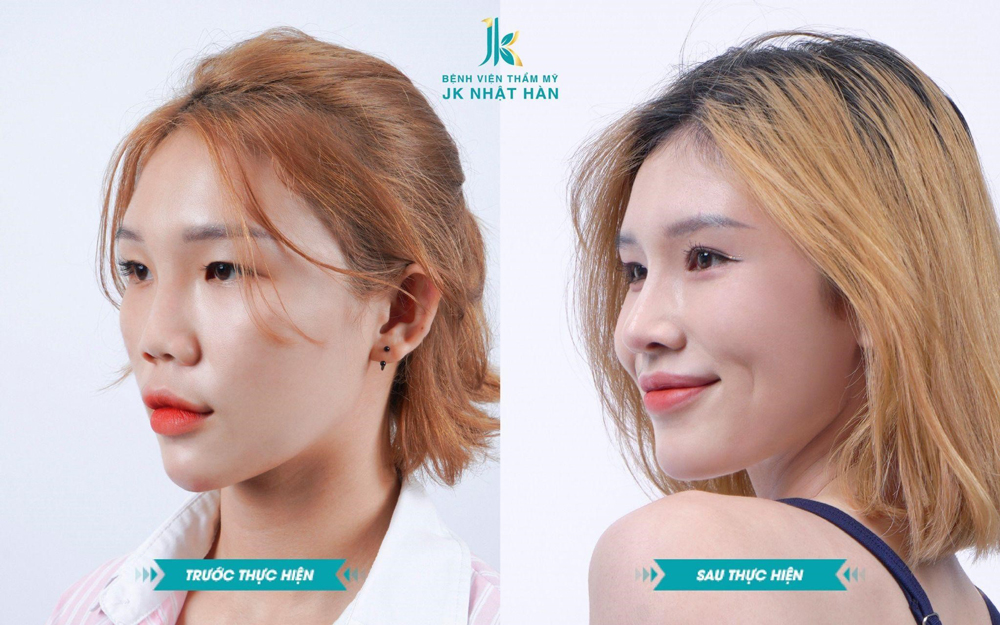 Bệnh viện JK Nhật Hàn chuyên sâu nâng mũi tiên phong tại Việt Nam