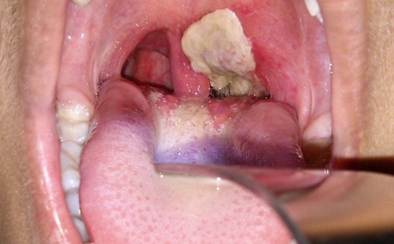 Cô gái 18 tuổi ở Nghệ An tử vong do bệnh bạch hầu