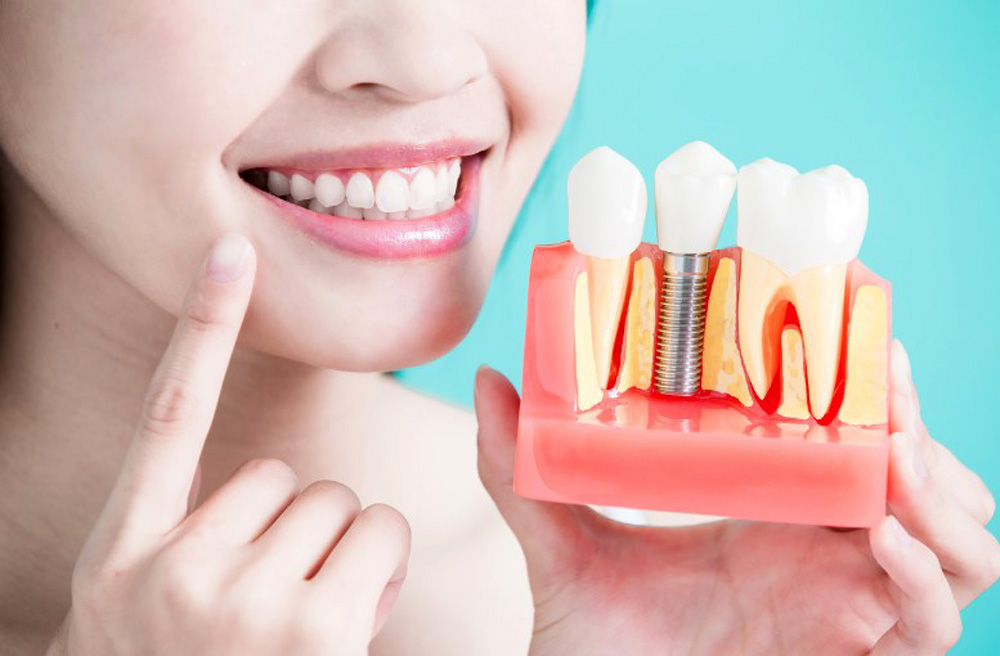 Implant là gì? Đây có phải là giải pháp hoàn hảo cho người bị mất răng