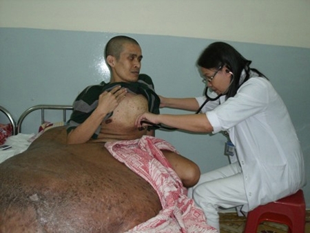 Chưa thể phẫu thuật cho người mang khối u khổng lồ