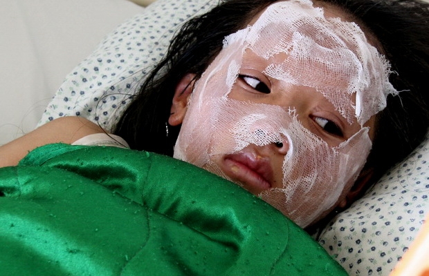 Chơi trò &quot;phù thủy&quot; – bé gái 11 tuổi bị bỏng