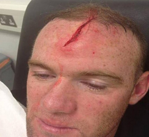 Ảnh chấn thương đầu của Rooney: Như phim kinh dị