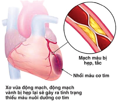 Các bệnh lý tim mạch là nguyên nhân hàng đầu gây đột qụy.
