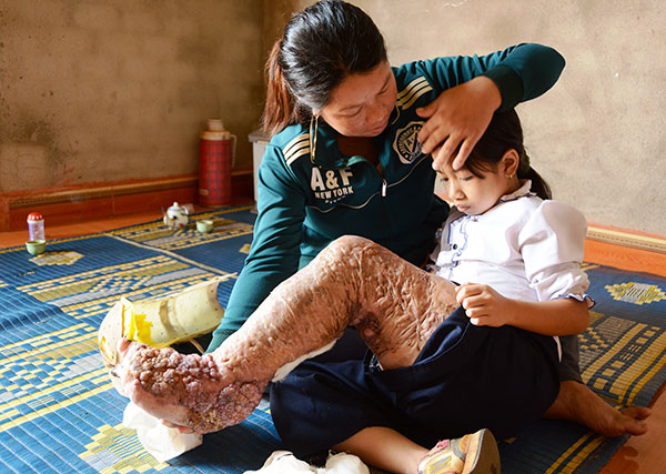 Nghị lực phi thường của cô bé &quot;chân voi&quot;