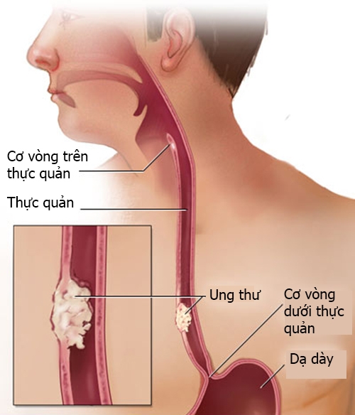 Nguy cơ ung thư thực quản do uống các đồ uống quá nóng