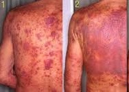 Thời tiết hanh khô, đề phòng viêm da cơ địa