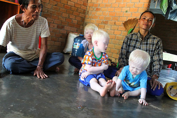 Những đứa trẻ bệnh bạch tạng cần giúp đỡ