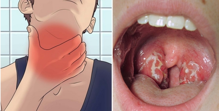 Bác sĩ cảnh báo: Trời lạnh hay mắc viêm họng và cách phòng
