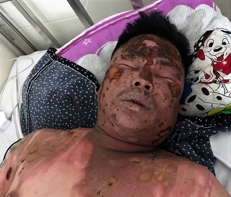 Đi dự đám cưới, nam thanh niên bị hất cả nồi lẩu đang sôi vào mặt