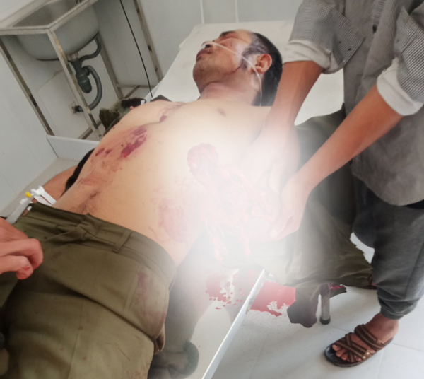 Chế mìn đánh cá, 1 người bị mất bàn tay