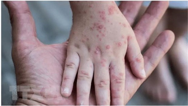 Ban đậu mùa khỉ nổi trên tay của một em nhỏ mắc bệnh ở nước ngoài