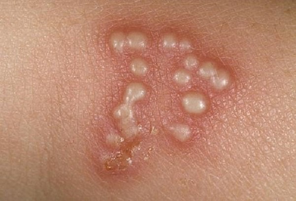 Nghiên cứu nguồn gốc căn bệnh viêm da phổ biến do nhiễm virus herpes